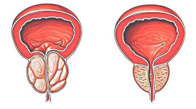 Prostatite et prostate normale