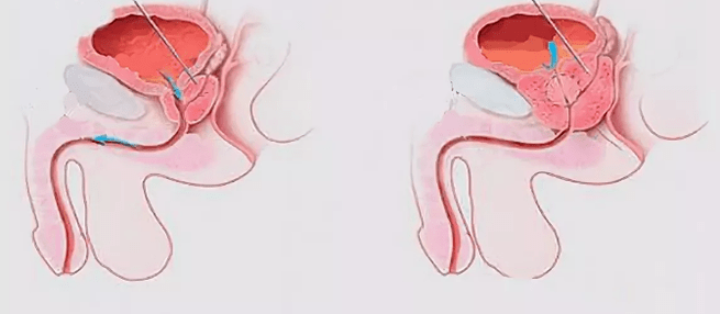 Signes de prostatite chez les hommes