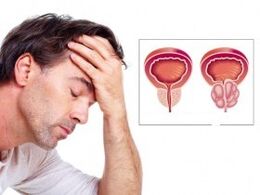 Prostatite chez un homme